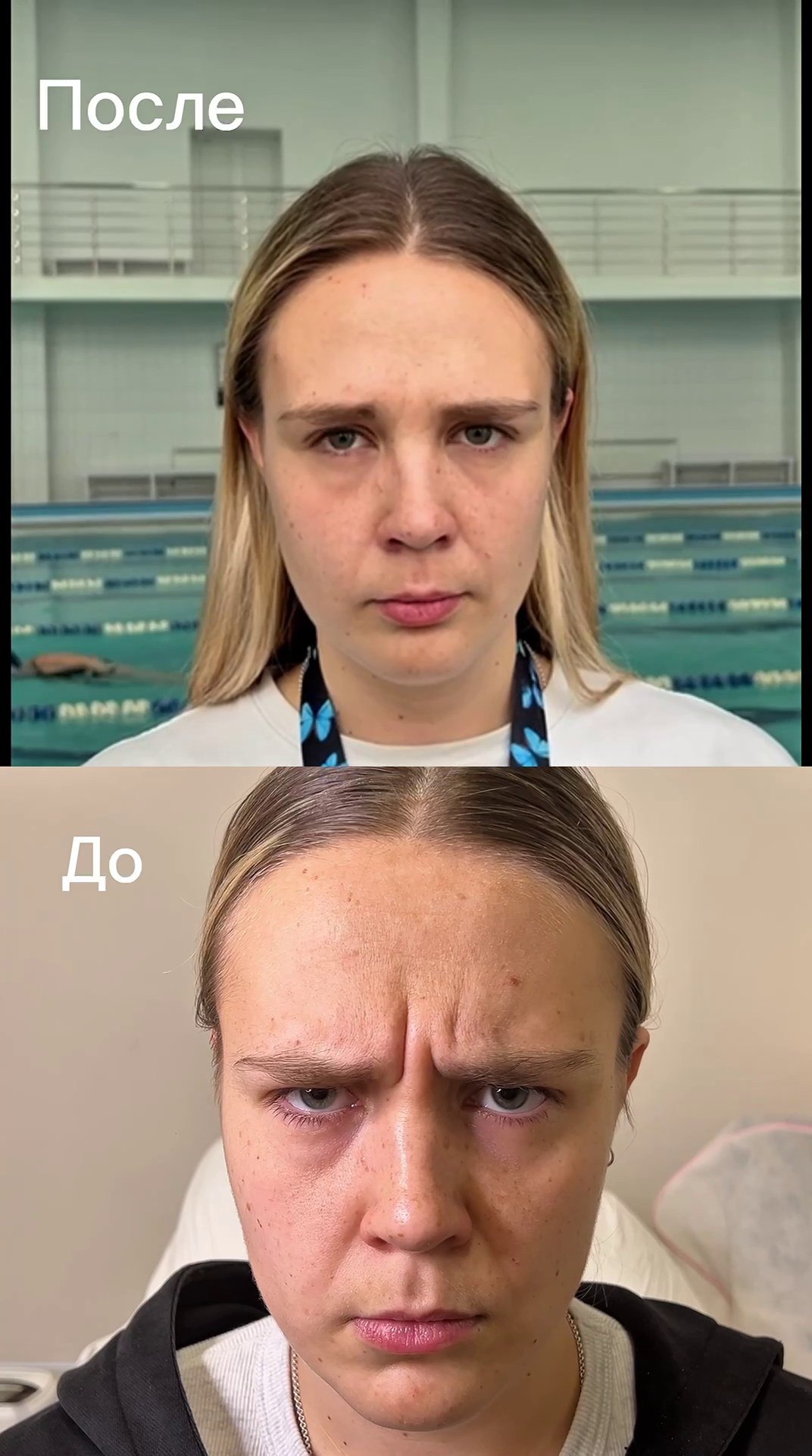 Работа Дарьи Белай: ботулинотерапия межбровья, до и после