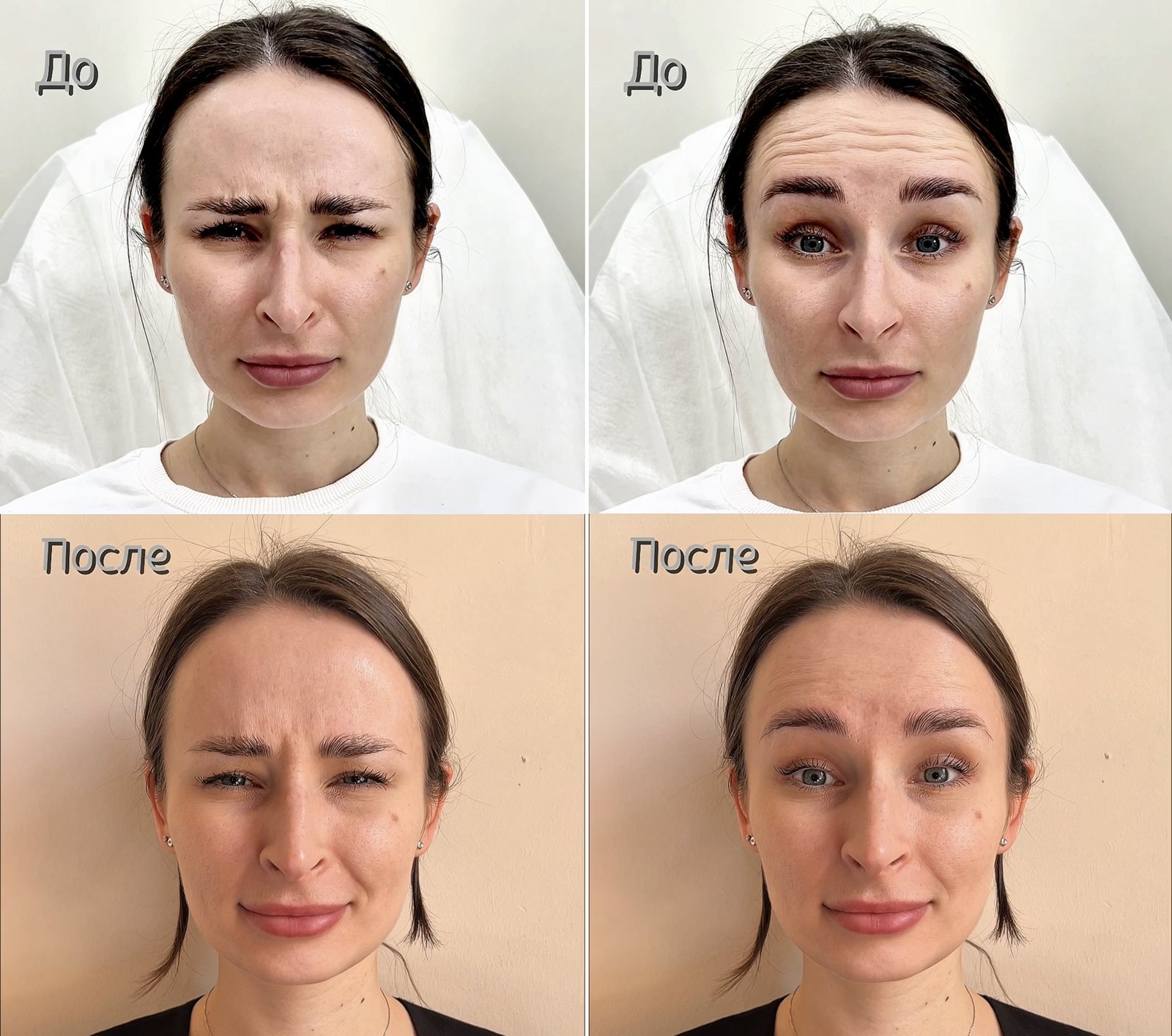 Ботулинотерапия лба и межбровья, до и после. Работа Дарьи Белай